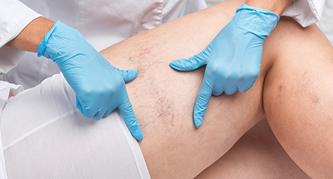 A person wearing blue medical gloves examines another persons thigh, which shows visible varicose veins. Both individuals are dressed in white clothing.