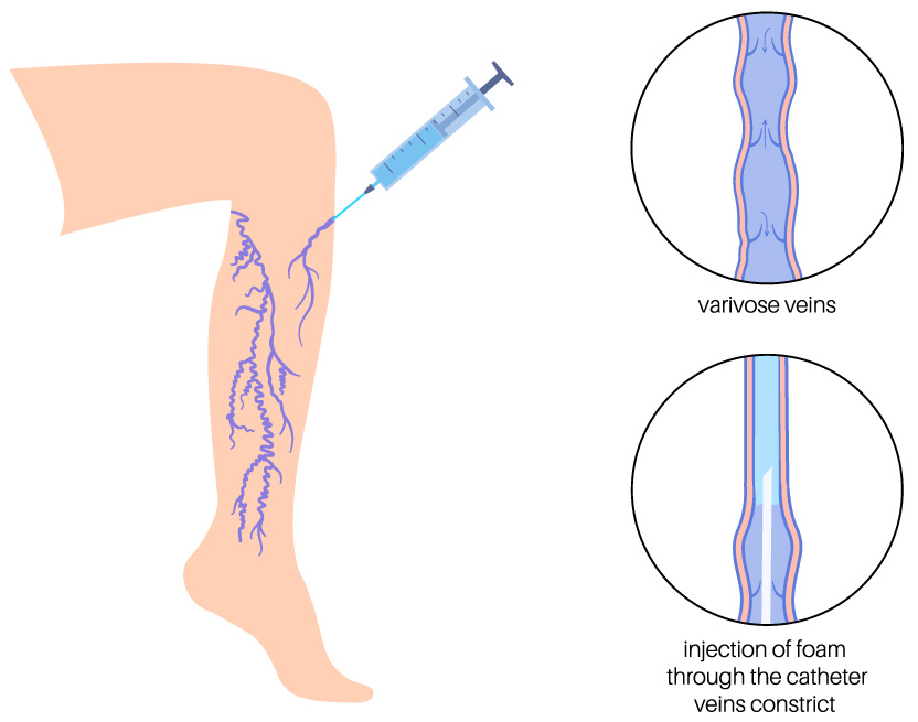 Illustration of a leg with varicose veins being treated by injecting foam with a syringe; insets show veins before and after foam injection, with the veins constricting after treatment.