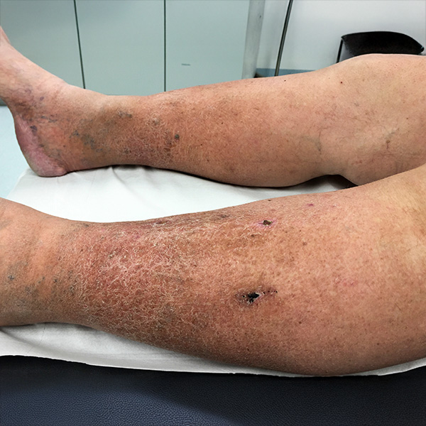 Close-up view of skin changes with hyperpigmentation and impaired wound healing due to chronic venous insufficiency after deep vein thrombosis