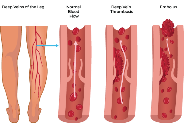 Diagram showing deep veins in a leg, followed by three vein cross-sections: normal blood flow, deep vein thrombosis with a blood clot, and an embolus where the clot breaks off and travels.