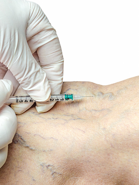 Removal of varicose veins with injection by a doctor in white gloves.