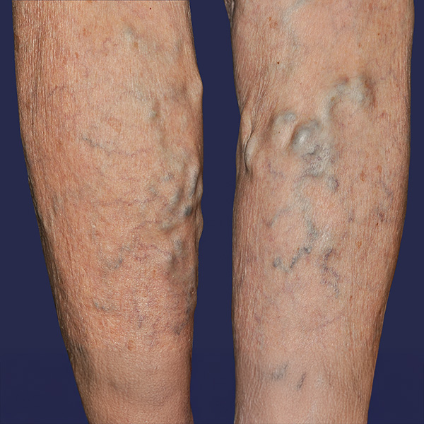 Two legs showing prominent, bulging, twisted veins under the skin, characteristic of varicose veins, with some discoloration and visible smaller veins. The skin appears aged.