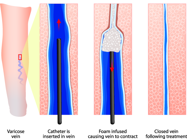 Varicose Veins. Endovenous foam Treatment. When injected inside a vein, the micro foam displaces the blood creating better contact with the vein wall. Sclerosant seals off the varicose veins.