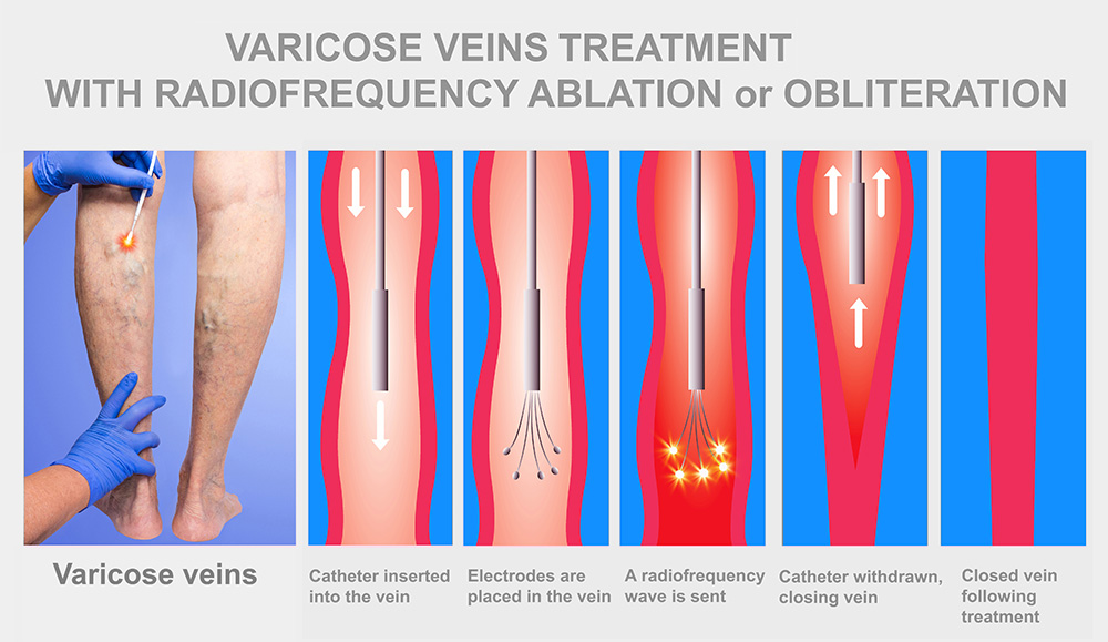 A step-by-step diagram showing varicose veins treatment with radiofrequency ablation, from catheter insertion and electrode placement to radiofrequency wave application, catheter withdrawal, and vein closure.